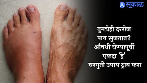 Leg Swelling 