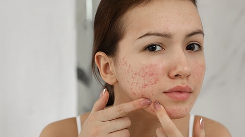 can constipation cause skin issues