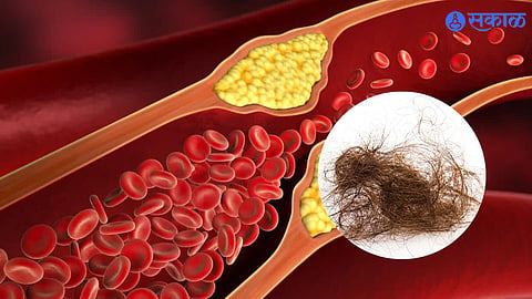 Cholesterol Symptoms 