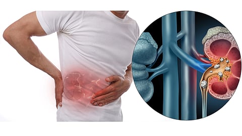 Kidney Stones