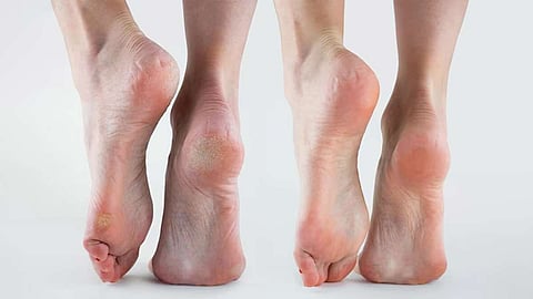 Crack Heels