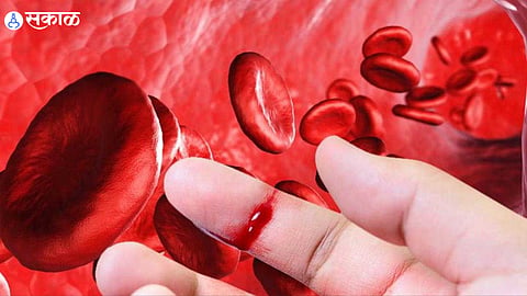 What Is Hemophilia