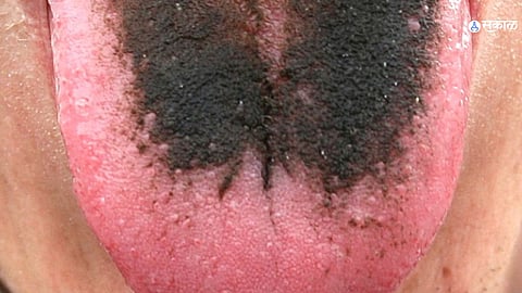 Black hairy tongue syndrome 