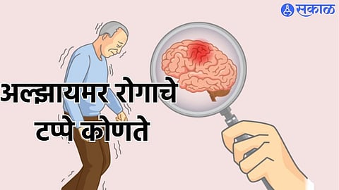 alzheimers disease stages and risk factors why are the elderly at risk 