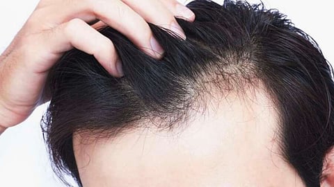 hairfall 