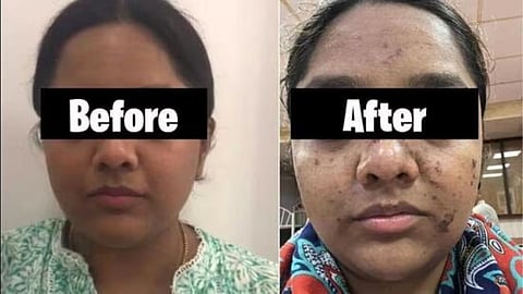 Mumbai Woman Face Burn