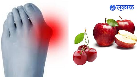 Uric Acid Remedies