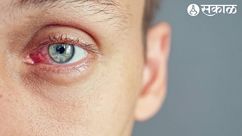Eye Infection