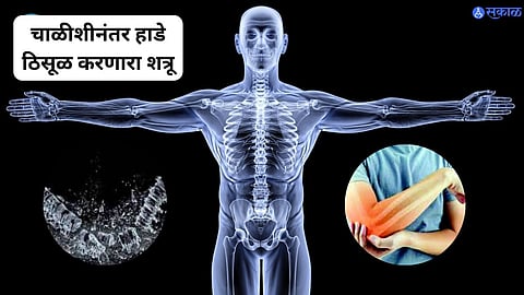 Osteoporosis 