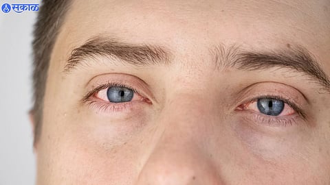 Eye Flu