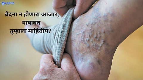 Vericose Veins