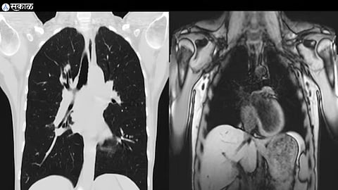 Difference Between MRI and CT scan