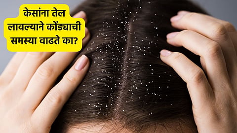 Dandruff 