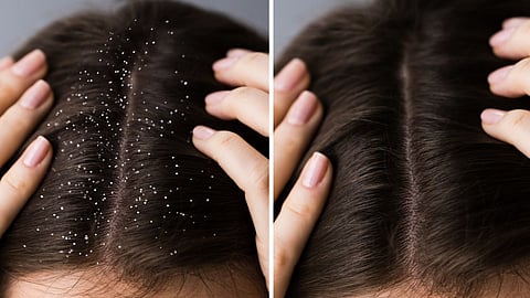 Dandruff 