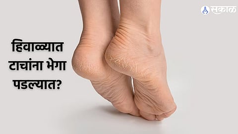 Cracked Feet 