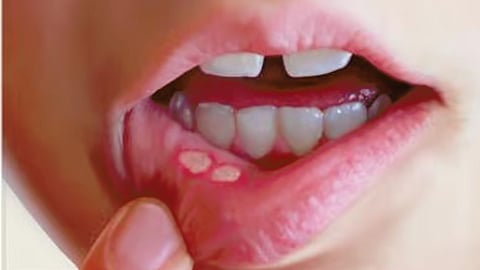 aphthae causes and tips for relife from them