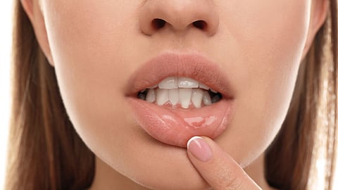 cold sores 