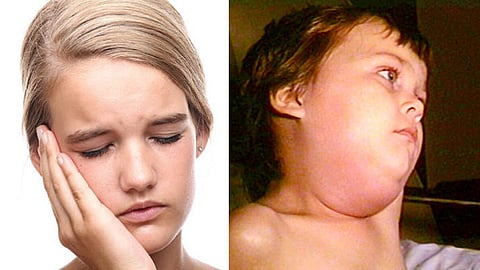 Mumps Infection