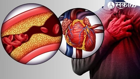 Heart Disease