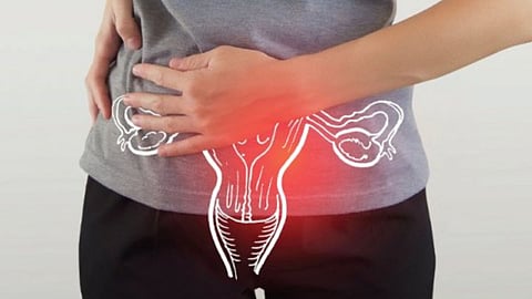 PCOS Disease