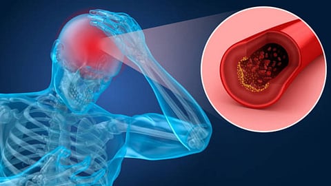 Brain Hemorrhage Symptoms 