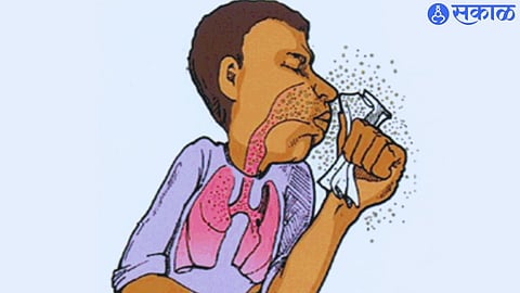 Tuberculosis 