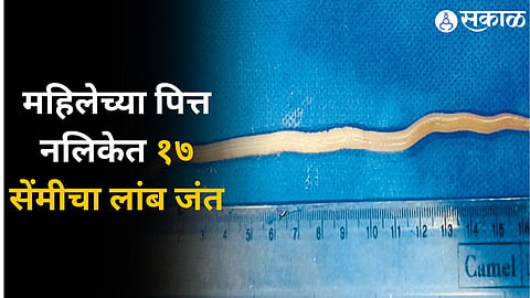 Worm in Bile Duct