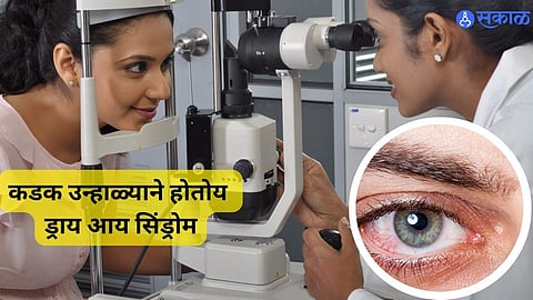 Dry Eye Syndrome : उन्हाळ्यात  लोकांना होत आहे ड्राय आय सिंड्रोम; वेळीच ओळखा लक्षणे! 
