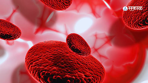 Thalassemia