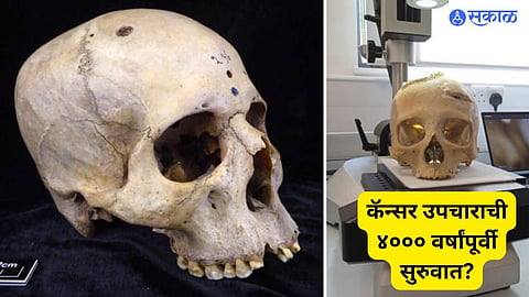 Ancient Egyptian Medicine: Cancer Treatments Found in 4,000 Year Old Skulls