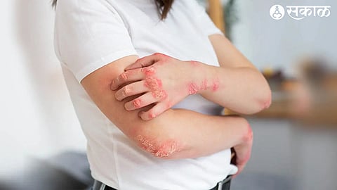 fungal infection