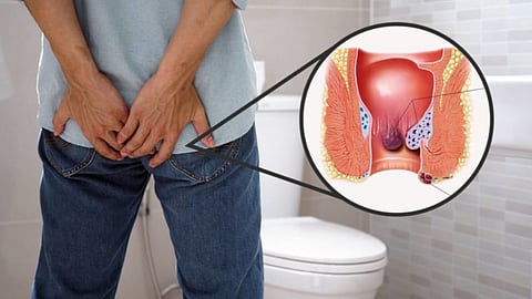 Piles Symptoms 