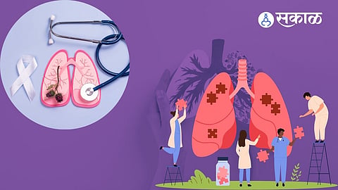 World Lung Cancer Day 2024: 