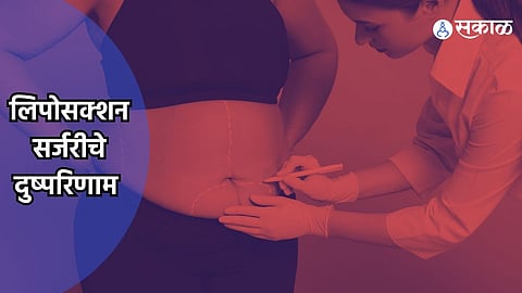 Liposuction Surgery