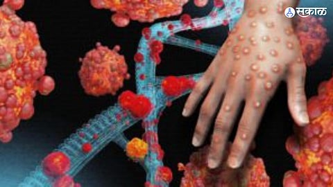Mpox 