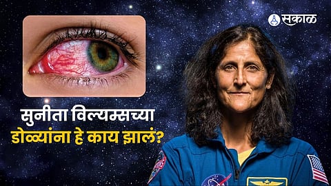 sunita williams facing eyesight issues in space