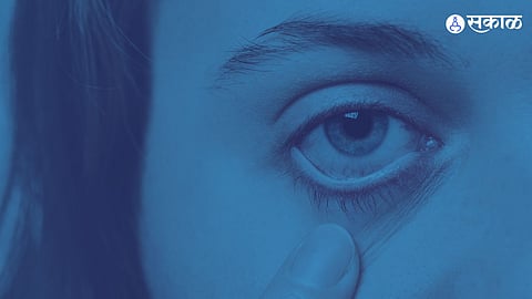 Eye Flue