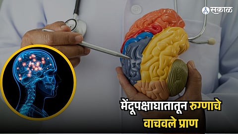 Brain Stroke Treatment