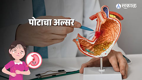 Gastric Ulcer: 