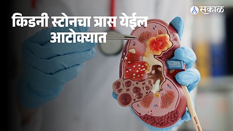 Kidney Stone Problem