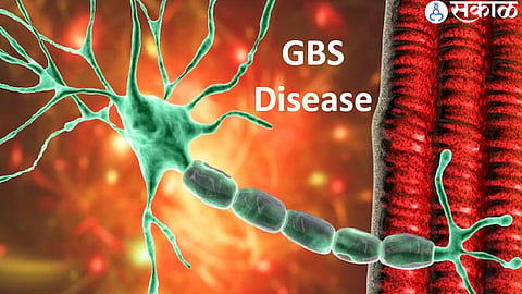 Health authorities in Asut are urging the public to follow safety measures after a GBS case was reported in the area."