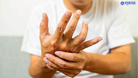 GBS Syndrome 