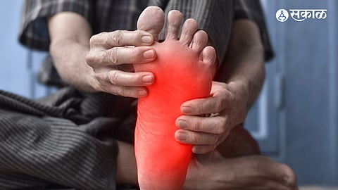 Neuropathy 