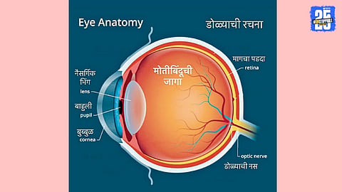 Eye Cataract