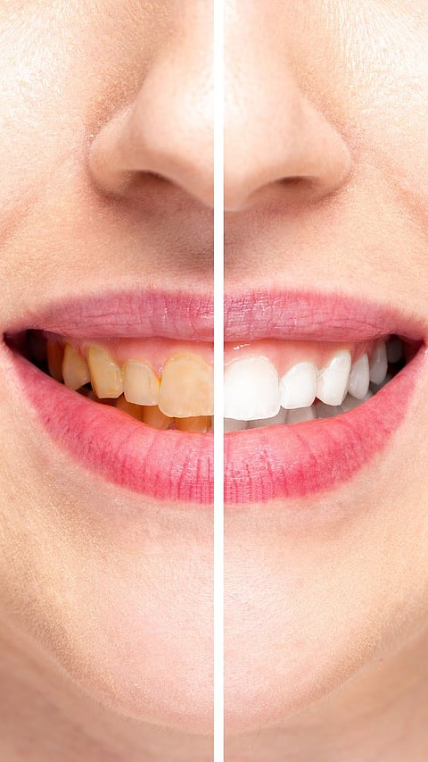 yellow teeth