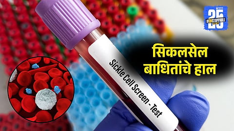 Sickle Cell Patients Denied Treatment Due to Lack of Hydroxyurea