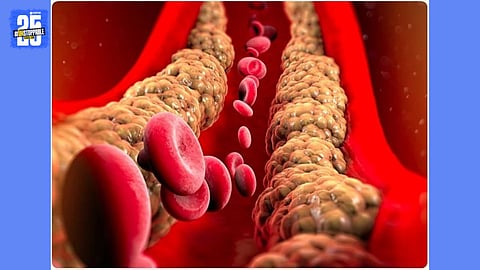 Triglyceride Levels