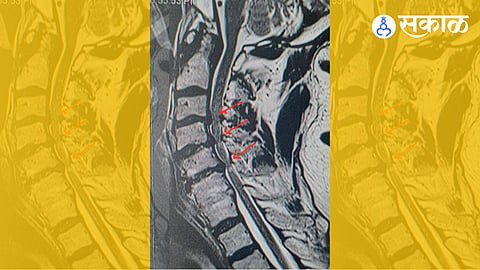 Spondylosis
