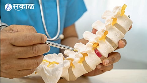 Process of Spinal Disc Rupture Explained