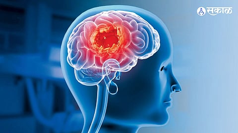 Clinical Success Stories: Defeating Clinoidal Meningioma and Brainstem Tumors with Absolute Precision